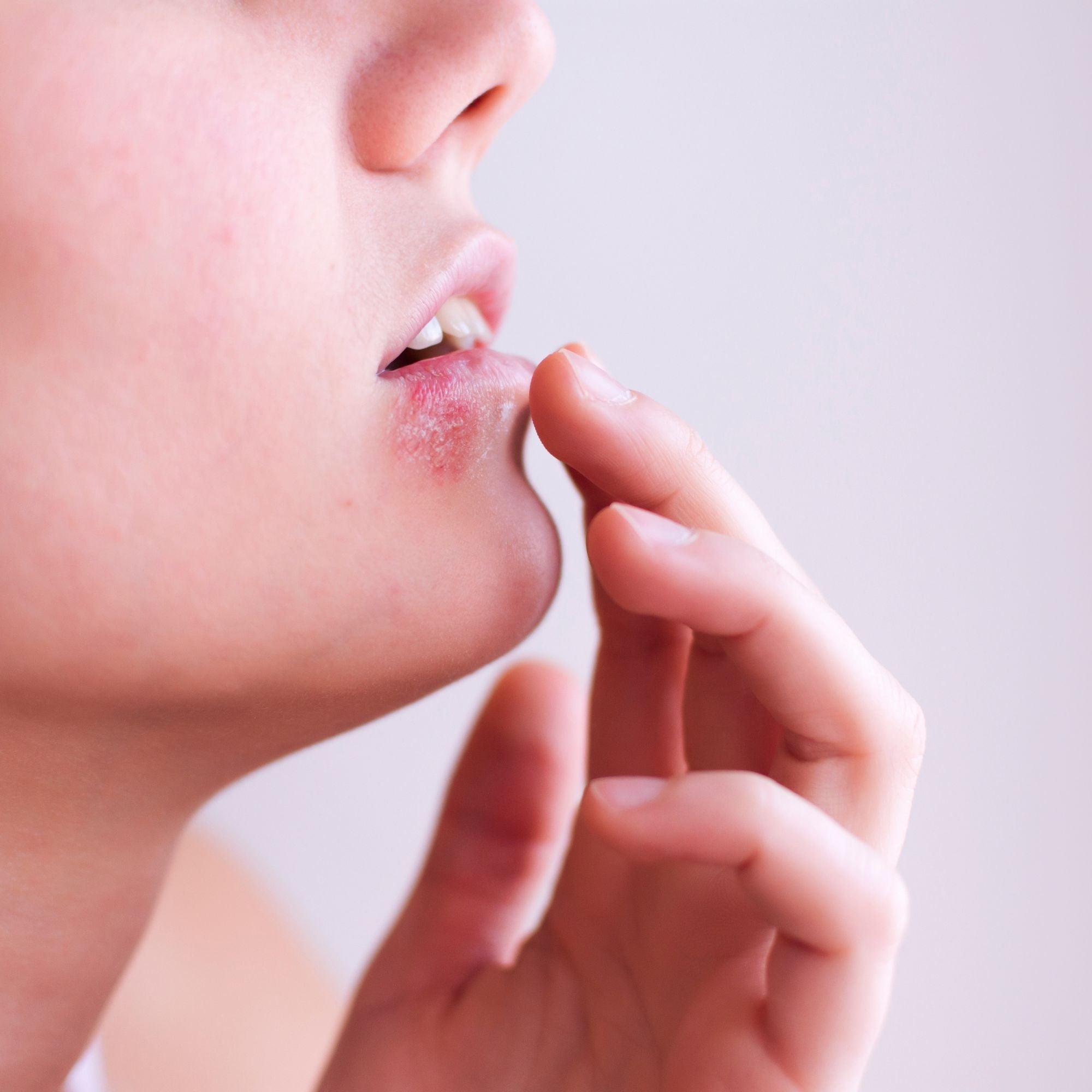 Tipps gegen Herpes