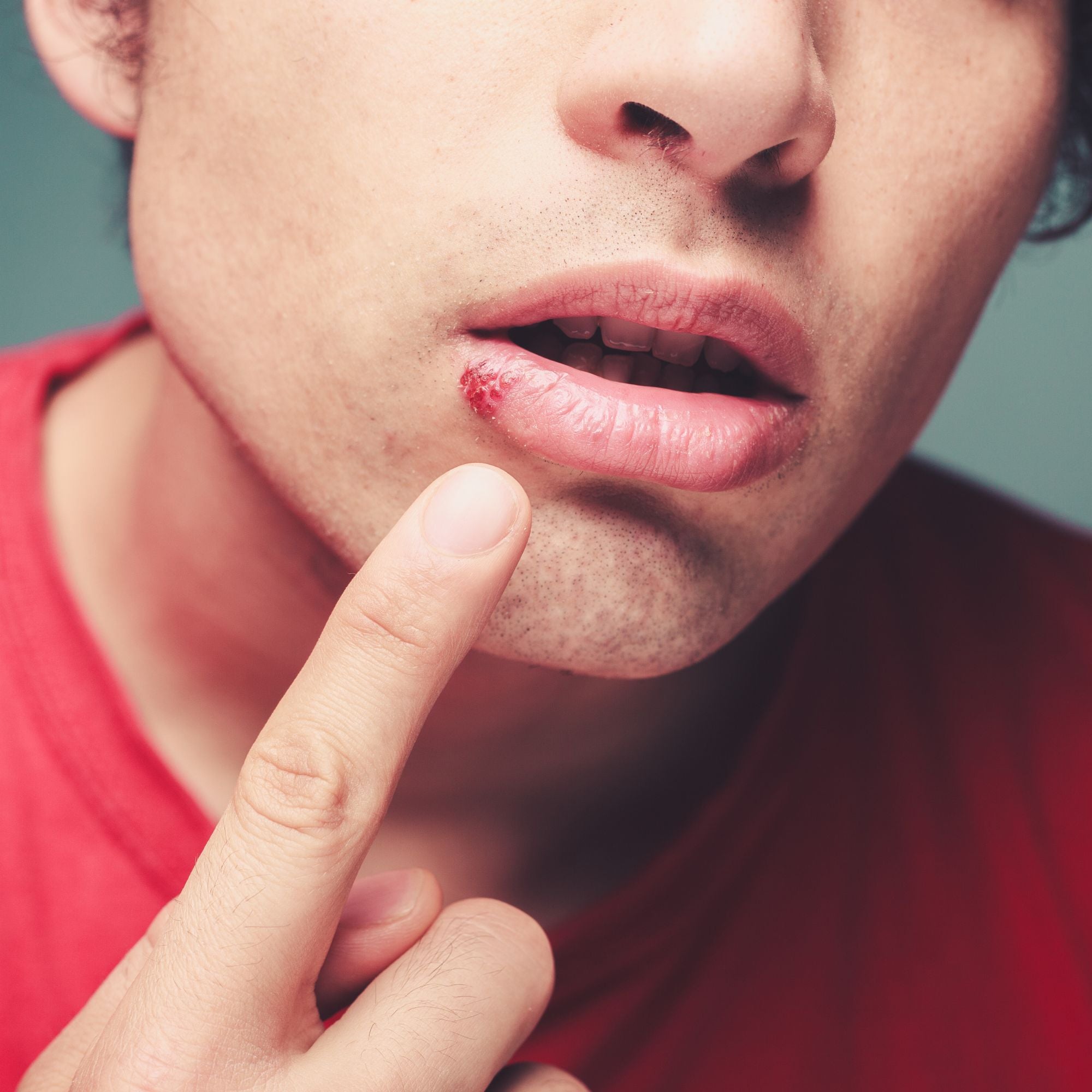 Lippenherpes verstehen und im Alltag begleiten