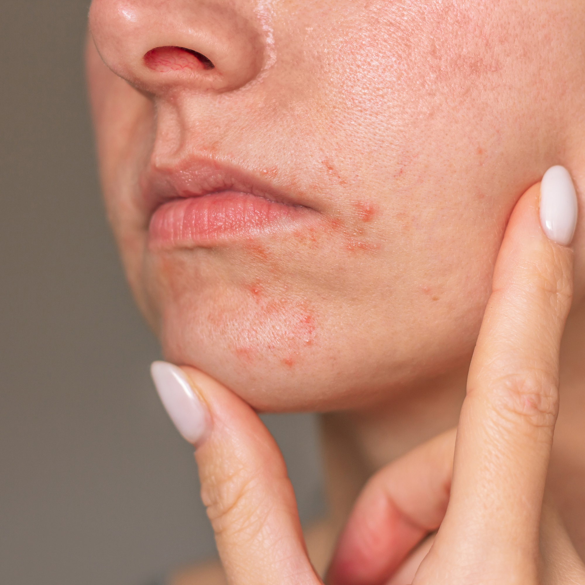 Periorale Dermatitis: Wenn die Haut ihr natürliches Gleichgewicht verliert